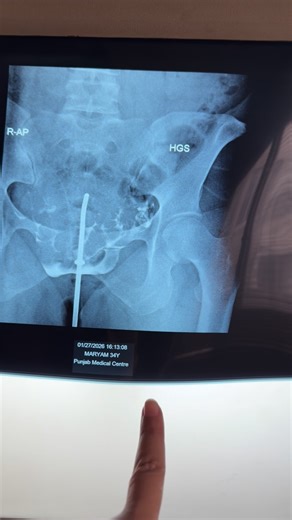 Dr.Heer Amir|obs&gyne | HYSTEROSALPINGOGRAPHY #fertility #fertilityjourney | Instagram