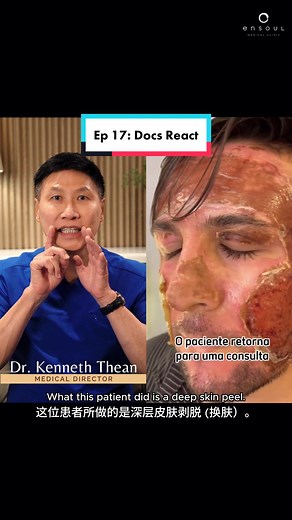 Chemical Peel Side Effects and Complications Explained by Dr. Thean