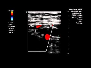 Bilateral Lower Extremity Arterial Duplex - Case Study