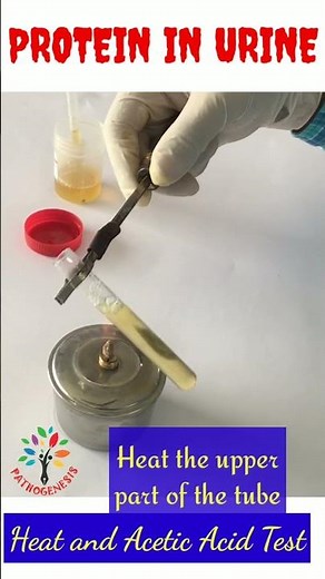 Protein in Urine ll Heat and Acetic acid test ll #shorts