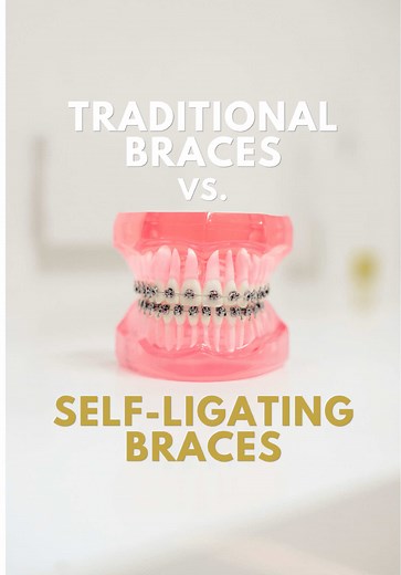 Self-Ligating Braces vs Traditional Braces: Key Differences