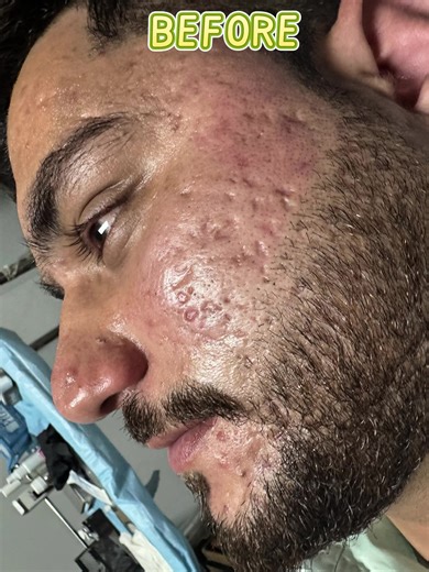 Effective Acne Scars Treatment: Before and After Results