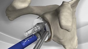 Total Shoulder Replacement with Univers™ II System