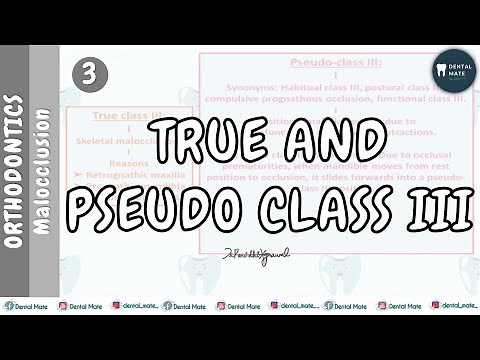 True class III | Pseudo class III malocclusion | Dr Paridhi Agrawal