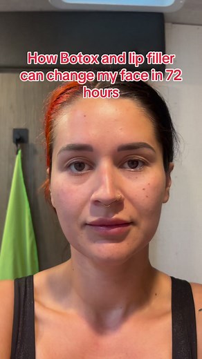 7.6K views · 17 reactions | Botox CHANGED my face! #botox #botoxinjections #fillers #fillersinjection | Mommashive | Facebook