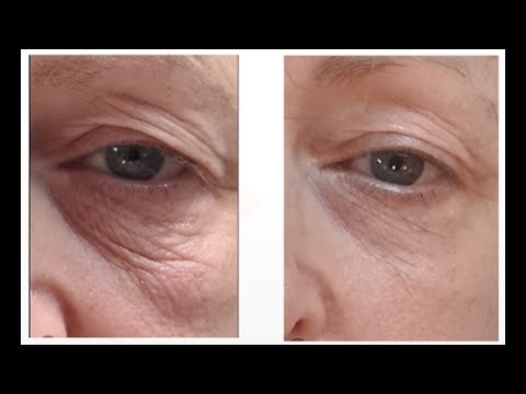 Sofwave offers non-invasive treatments to soften fine lines & wrinkles