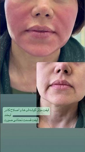 Effective Corner Lip Lift with Filler Injections | Enhance and Elevate with Method X