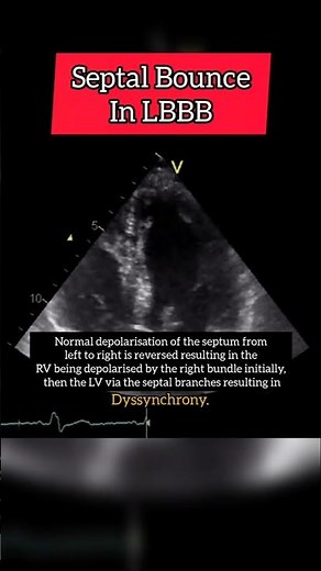 Septal Bounce in LBBB on Echocardiography #heart #shorts