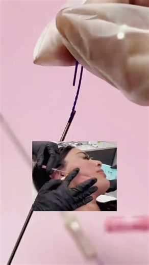 ✨ PDO Fishbone Threads – Lift with Precision Shape, contour, and lift with advanced PDO Fishbone Threads. Designed with multi-directional barbs for stronger hold, enhanced definition, and long-lasting rejuvenation. Perfect for jawline sculpting, cheek lifting, and overall facial tightening. 📦 In stock & ready to ship 📩 DM for pricing, catalog & wholesale offers #PDOFishboneThreads #FishboneThreads #PDOThreads #FacialLifting #SkinTightening