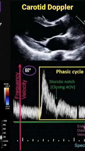 Carotid Doppler Patterns