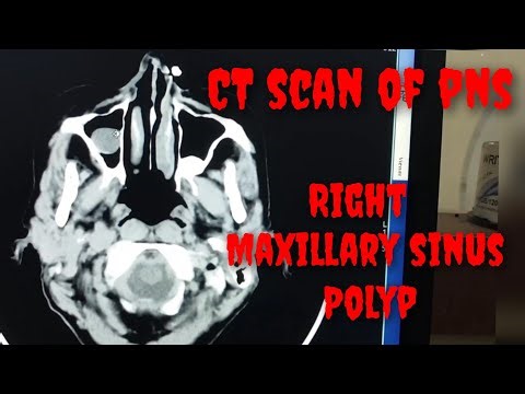 Right Maxillary Sinus Polyp || CT Scan of PNS || CT Scan of Brain || ‪@radiographywithprasad6383‬