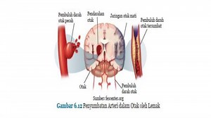 Apa Itu Digital Subtraction Angiography, yang Sembuhkan Inul Darasista dari Penyumbatan Darah Otak? - Tribunnews.com