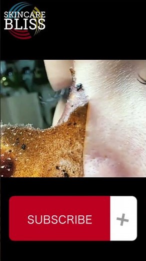 remove black and whiteheads on face at home