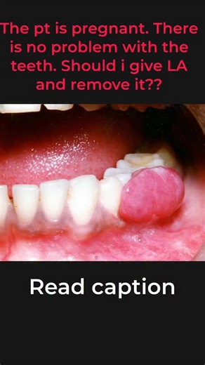 Dr.Vinayak Thorat- Dental Education on Instagram: "🦷 Likely Diagnosis: 👉 Pregnancy Tumor (aka Pyogenic Granuloma / Lobular Capillary Hemangioma) 🔍 What is it? A benign, vascular, inflammatory gingival growth commonly seen in pregnant patients. Despite the scary look, it is NOT cancer ❌ and NOT an infection ❌. 🤰 Why is it seen in pregnancy? Because of hormonal changes: • ↑ Estrogen & Progesterone 🧬 • These hormones: • Increase vascularity • Increase inflammatory response • Exaggerate reactio