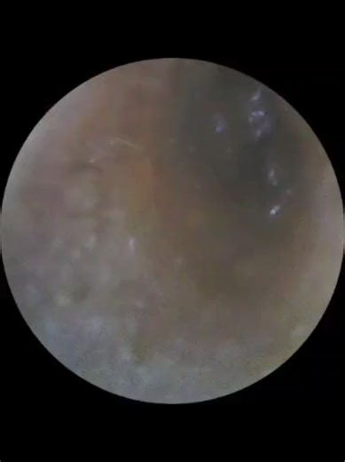 Before and after removing Ear wax. Ear pain gone. Client had a lot of pain in the ear. Ear wax can cause pain, loss of hearing, itchyness & a feeling of fullness in the ear. Impacted earwax can affect your sense of balance and coordination, especially in older adults #earwax #ears ##earwaxremoval #earpain #earwaxcleaning