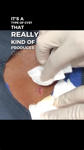 Sandra Lee, MD, FAAD, FAACS on Instagram: "Who loves the steatocystomas over on YouTube? 🙋🏻‍♀️⁠ ⁠ Click here to watch the full video at the link in bio!⁠ ⁠ #drpimplepopper #popaholics #pimplepopping #dermatologyy #medicaleducation"