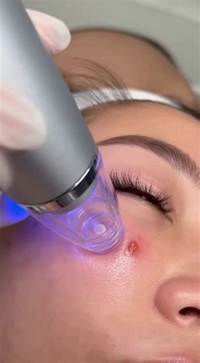 Small pimples but super annoying 😤 #blackheads #acne #skincare #healing #fyp