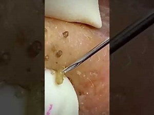 Blackhead removal from nose/ old aged blackheads removal/ cystic blackheads whiteheads removal