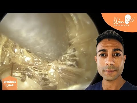 1,049 - Thick Infected Matted Ear Discharge & Ear Wax Removal