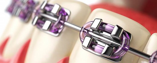 ¿Cuánto tiempo tendré que llevar brackets? - Dentisalut