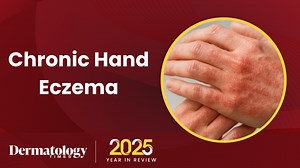 Dermatology Times 2025 Year in Review: Chronic Hand Eczema | Dermatology Times