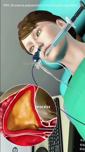 Balloon Sinuplasty Procedure#science #acltear #atherenergy #balloon#doctor