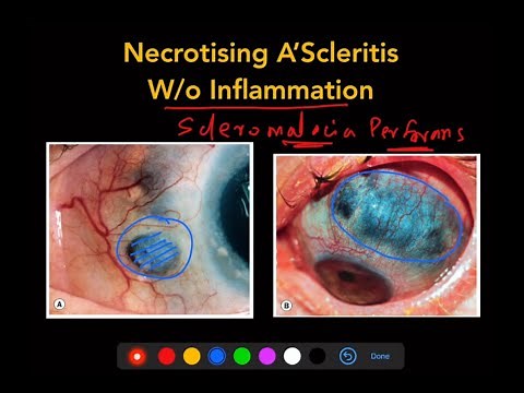 Scleritis - The Complete Course