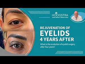 Eyelid rejuvenation and occidentalization - 4 years after the procedure - 25231