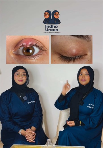 Understanding Styes and Chalazions: Key Differences