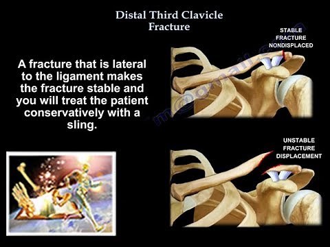 Distal Third Clavicle Fracture - Everything You Need To Know - Dr. Nabil Ebraheim