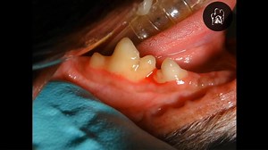 Tips to extract- In this video, Dr. Brett explains tips and tricks to extract in complex situations Join Dr. Brett for 2 Fantastic Days of Intense Surgical Instruction that will give you the Skills to Master Surgical Extractions. Don't Wait -Join the wet lab's training now- https://veterinarydentistry.net/veterinary-dental-ce-veterinarian-courses-dentistry/ | Veterinary Dentistry Live