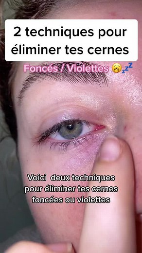 Tendances Skincare : Cernes Violette et Astuces Naturelles