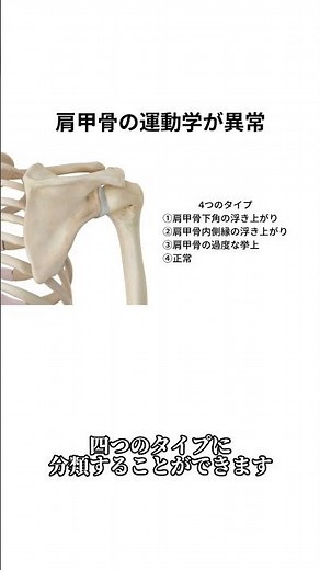 【病態】翼状肩甲