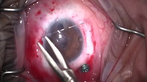 Traumatic Aphakia, Sutured IOL, Pupilloplasty - Eyetube
