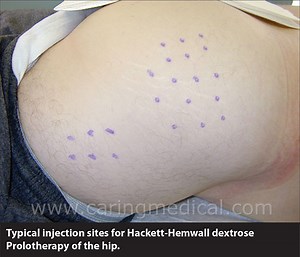 Greater trochanteric pain syndrome and hip bursitis treatment