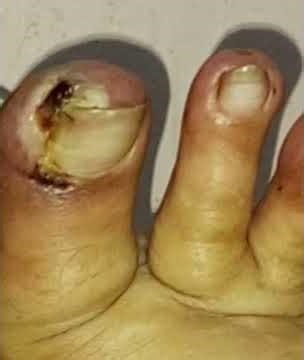 stress causes Scleroderma#disease#nature#stress#highbloodpressuresymptoms