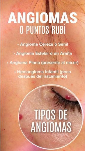 ANGIOMAS O PUNTOS RUBÍ
