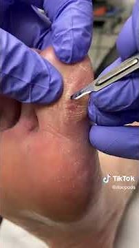 How to Remove Painful Seed Corn and Callus (Hard Skin) By an Australian Podiatrist