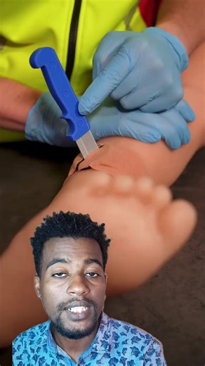 first aid for impaled object #habeshatiktok #health #fyp #viralvideo