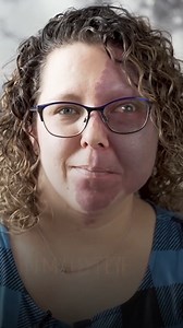 136K views · 2.2K reactions | My life with Sturge-Weber Syndrome 懶 #fbreels #borndifferent #sturgeweber #sturgewebersyndrome #portwinebirthmark #glaucoma | Born Different | Facebook