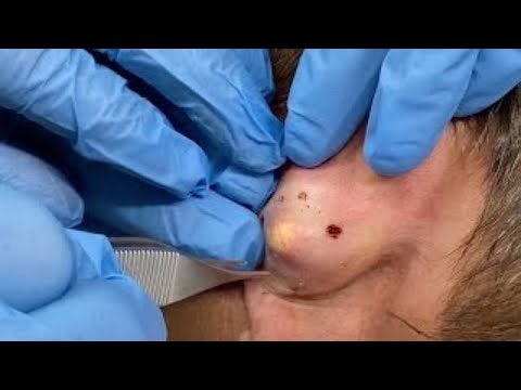 I Had an Ear Cyst Removed and You Won't Believe What Happened Next