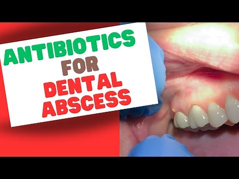 Antibiotics for Dental Abscess: When to Take Them and How Long?