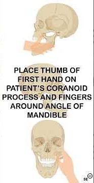 Extra-oral mandible reduction (animation)