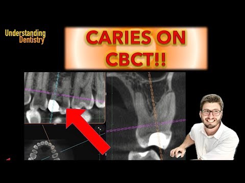 EASY Detecting CARIES on CBCT scans… (and dealing with CBCT artifacts!!)