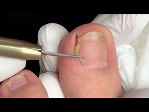Extreme Ingrown Toenail Removal by Dermatologist | Deep Cleaning Treatment 2025