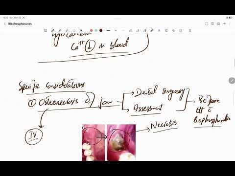 Bisphosphonates | All Important Aspects: Mechanism, Uses & Side Effects