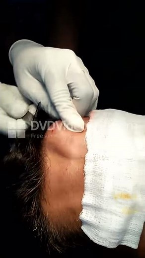 Brow Lift Surgery