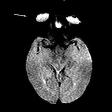 Normal brain perfusion