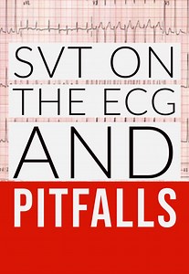 SVT on the ECG! — USF Emergency Medicine