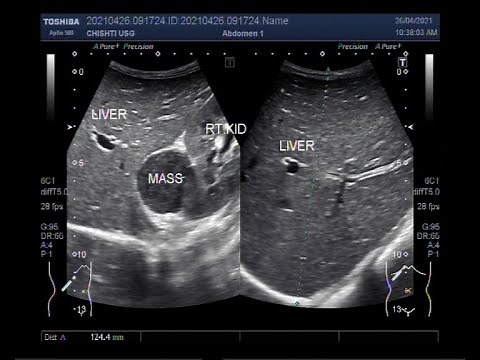 Mass in Morison's Pouch.